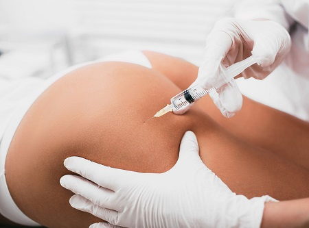 Lipoescultura y aumento de glúteos con grasa corporal