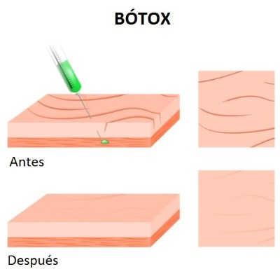 Antes y después del bótox