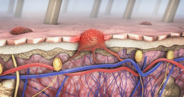 Melanoma en la piel