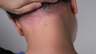 La psoriasis capilar provoca placas rojas cubiertas por una escama gruesa